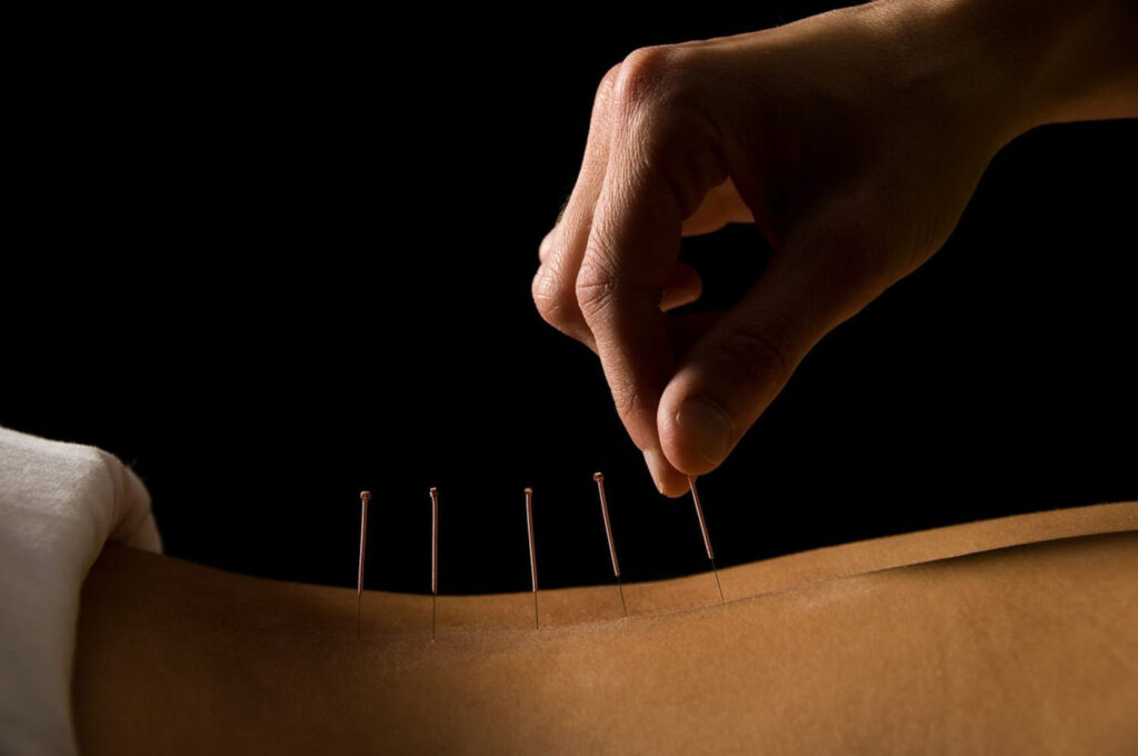 Acupuncture-2